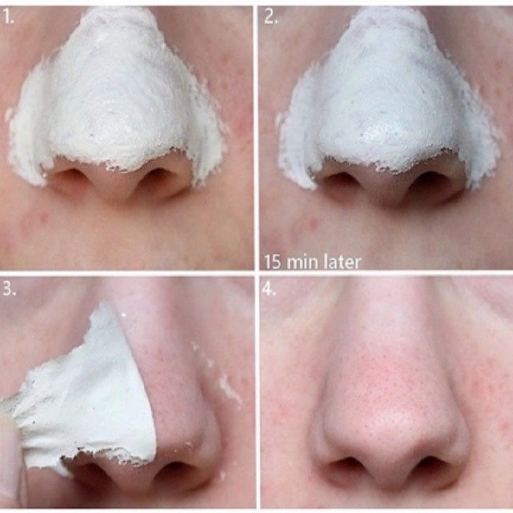 KEO LỘT MỤN ĐẦU ĐEN HANDMADE - Bán Từ 2 Tuýp