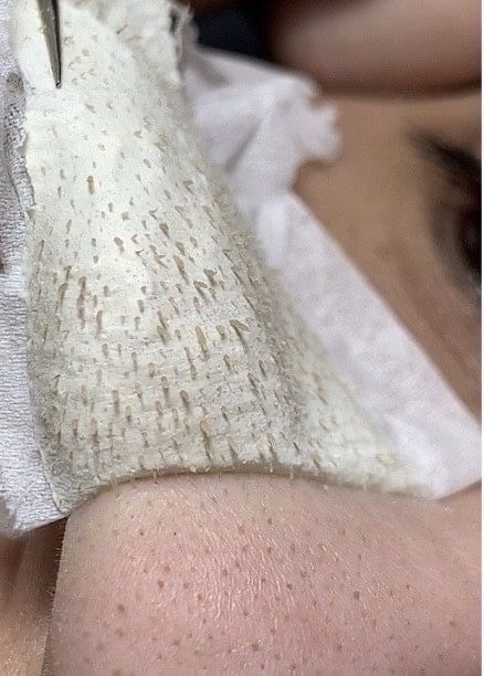 KEO LỘT MỤN ĐẦU ĐEN HANDMADE - Bán Từ 2 Tuýp